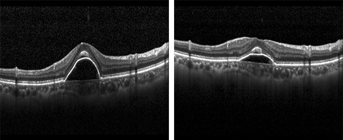 图1:治疗当天黄斑区水肿明显 图2:“布西珠单抗”治疗后10天复诊,黄斑水肿明显好转